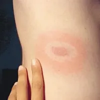 Okužba z boreliozo