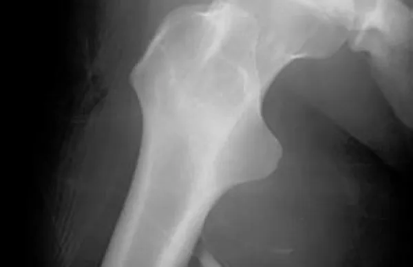 Osteoporoza, najpogostej&scaron;a kronična bolezen