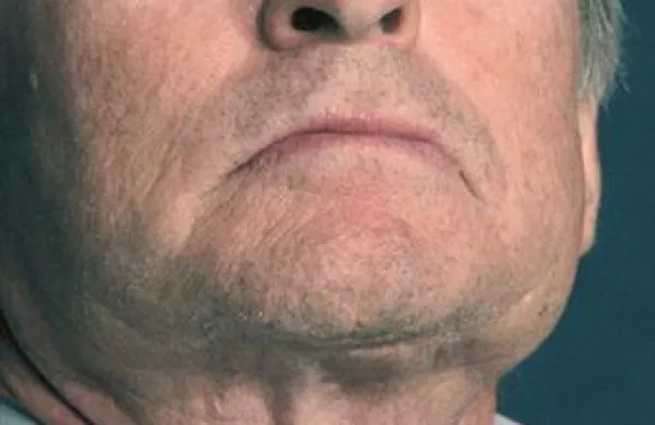 Michael Douglas je diagnozo raka javnosti razkril septembra lani.