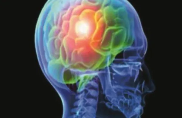 Epilepsija je motnja, žarišče je v delovanju možganov  