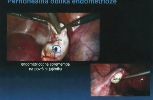 Pri peritonealni  endometriozi kaže posnetek cisto na jajčniku (zgornja slika) in zdrav jajčnik ter rodila (spodaj desno) 