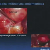 Oblika globoke infiltrativne endometrioze je cista na črevesu, ki se je zaradi obolenja nekako prilepil na maternico (zgoraj desno), spodaj je posnetek zdravih rodil  