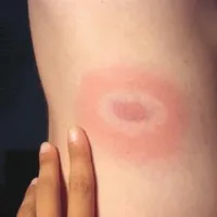 Če se čez nekaj časa pojavi značilna rdečina z obrobo, je treba k zdravniku 