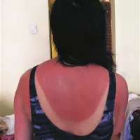 Sončne opekline so nevarne, pripomorejo lahko k nastanku kožnega raka.