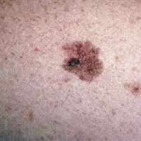 Na znamenju se je pojavil melanom.