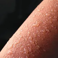 Posledica hudih opeklin so mehurji