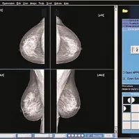 Mamogram natančno pokaže vse vrste tvorb v dojkah