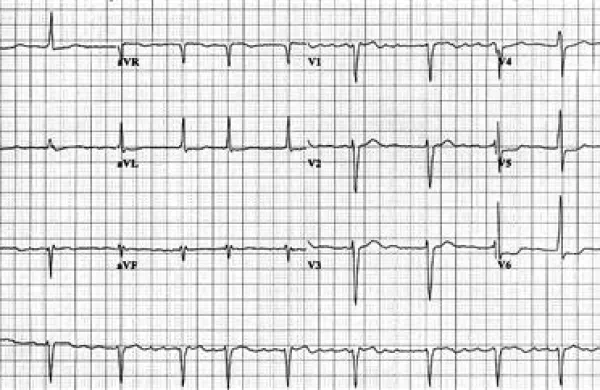 Preiskava z EKG napravo in izvid odkrijeta in potrdita atrijsko fibrilacijo 