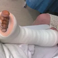 V Istri se vrstijo hudi zlomi okončin zaradi divjanja z motorji