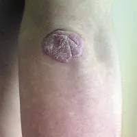Značilni luskavični plak na komolcu