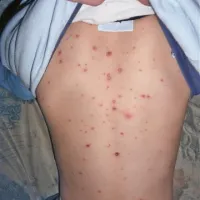V Istri je epidemija vodenih koz letos prehitela gripo, obe bolezni pa sta zelo nalezljivi