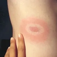 Znamenje na koži, da vas je klop okužil