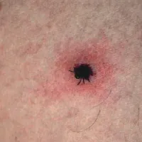 S klopnim meningoencefalitisom se okužimo ob piku okuženega klopa  