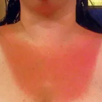 Značilna mestna opeklina - posledica sprehoda po soncu, ko koža ni bila primerno zaščitena. ne pozabite, da si koža vsako takšno nespametnost zapomni in se slednje z leti seštevajo.