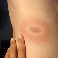 Značilen pojav na koži po ugrizu klopa, ki nakazuje, da gre za okužbo z Lymsko boreliozo  