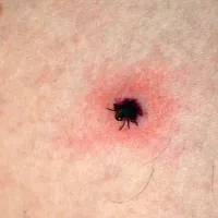 Ko se klop že zarije v kožo in prične sesati kri, ga ne smete kar odtrgati ali zadušiti s kapljico olja, saj tedaj izbrizga v telo svojo, morda okuženo slino    