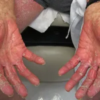 Takšne izpuščaje in osip po koži pa povzročajo ošpice.