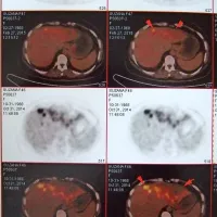 Pet scan je pokazal, da se je tako velikost 
tumorja kot njegova aktivnost (rumeno obarvano) od lanskega oktobra (spodnja vrsta) do 
konca februarja (zgornja vrsta) precej zmanjšala. 
“Še malo in bo povsem izginil,” je optimistična 
Suzana Sekuloska.