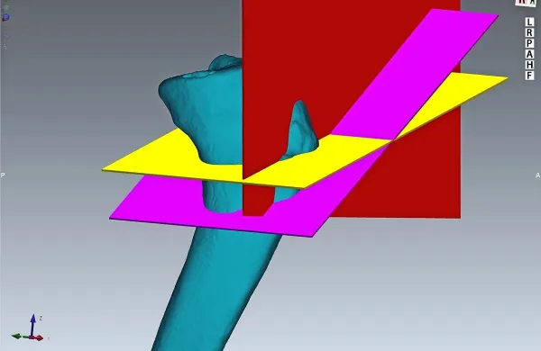 pridobijo 3D rekonstrukcijo kosti, hkrati s simulacijo potrebnega posega in virtualno izdelavo načrta. 