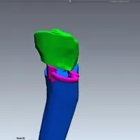 Na podlagi 3D načrta v predel prežagane kosti vstavijo po meri 
narejene vmesnike in osteotomijo učvrstijo s ploščo ter vijaki.

