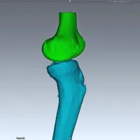 Pri kompleksnih deformacijah kosti (kot ta na golenici),    s predoperativno CT napravo pridobijo 3D rekonstrukcijo kosti, hkrati 
s simulacijo potrebnega posega in s pomočjo virtualne simulacije  izdelajo načrt operacije.