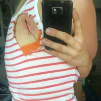 Mojca je utrpela tudi štiri centimetre veliko raztrganino na 
hrbtu, zaradi česar  so ji predpisali antibiotike, bila pa je tudi v 
antirabični ambulanti v Kopru. 
