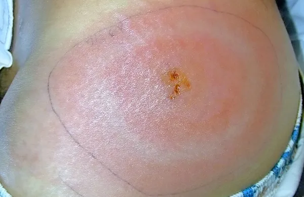 Pri novi obliki borelije se po ugrizu klopa na koži ne pojavi več 
značilna rdečina. 