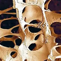 Oboleli ne ve, da boleha za osteoporozo, boleznijo krhkih 
kosti.  