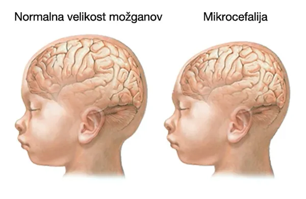 Slovenski raziskovalci so prvi na svetu dokazali, da okužba z 
virusom zika med nosečnostjo povzroča možganske okvare 
ploda.