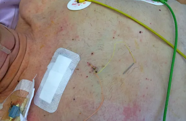 Takšna majhna rana, ki se po dveh, treh dneh zaceli in gre 
lahko bolnik že domov, ostane po  opravljenem posegu na 
novi način. 