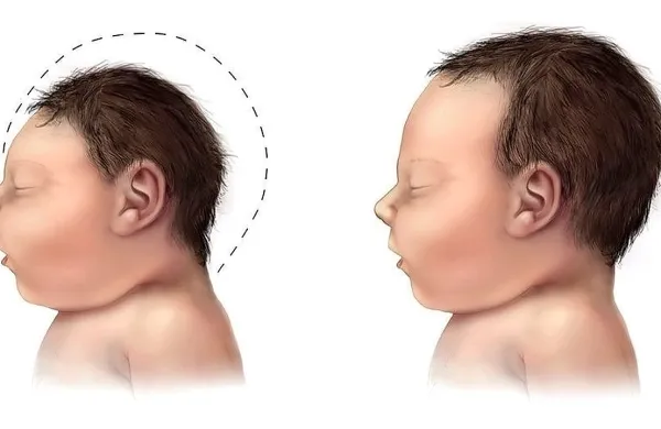 Virus zika pri večini obolelih sproži le kratkotrajne, gripi 
podobne simptome, a velja za zelo nevarnega za nosečnice 
oz. plod. Kriv naj bi namreč bil za mikrocefalijo, prirojeno 
napako pri novorojencih, ko se ti rodijo z nenavadno majhno 
glavo. To lahko povzroči možganske poškodbe.