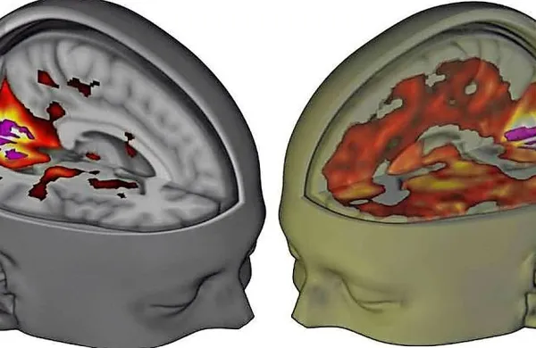 Slika prikazuje, kako z zaprtimi očmi veliko večji del možganov prispeva k vizualnim izkušnjam pod vplivom LSD kot pod 
učinkom placeba. 