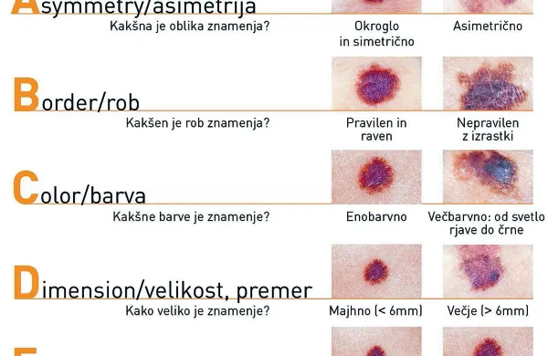 Na melanom opozarja plakat, ki so ga pripravili dermatologi 
in vsebuje temeljne napotke postopka, na kaj je treba biti 
pozoren zaradi spremembe znamenja, ki se je  razvilo v 
rakavo.  