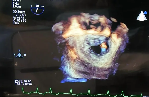 

 

3D ultrazvočna predstavitev srca med implantacijo zaklopke. 