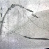  

Rentgenska slika predstavitve položaja mitralne sponke (po 
postavitvi in med posegom). 