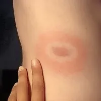 Lymska borelioza se običajno začne z rdečino.