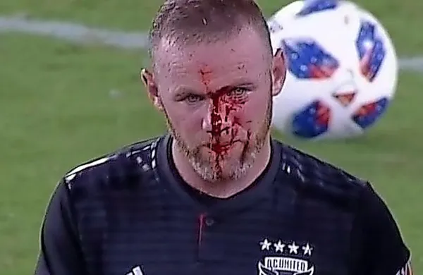 Proti koncu tekme  si je Rooney med akcijo v obrambi zlomil 
nos.