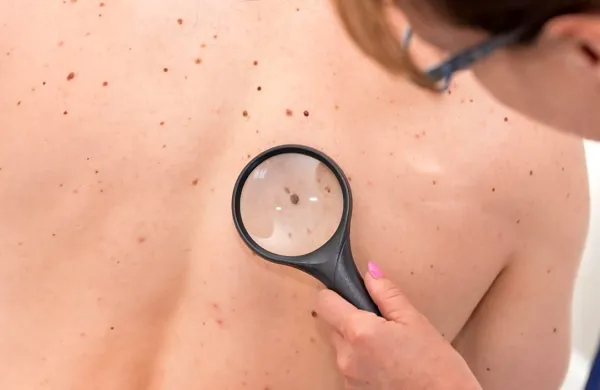 V letu 2020 odkritih 35 odstotkov manj melanomov kot pred epidemijo