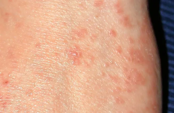Na eni od gorenjskih osnovnih šol so se pri dveh učenkah, ki se 
družita, pojavile garje.